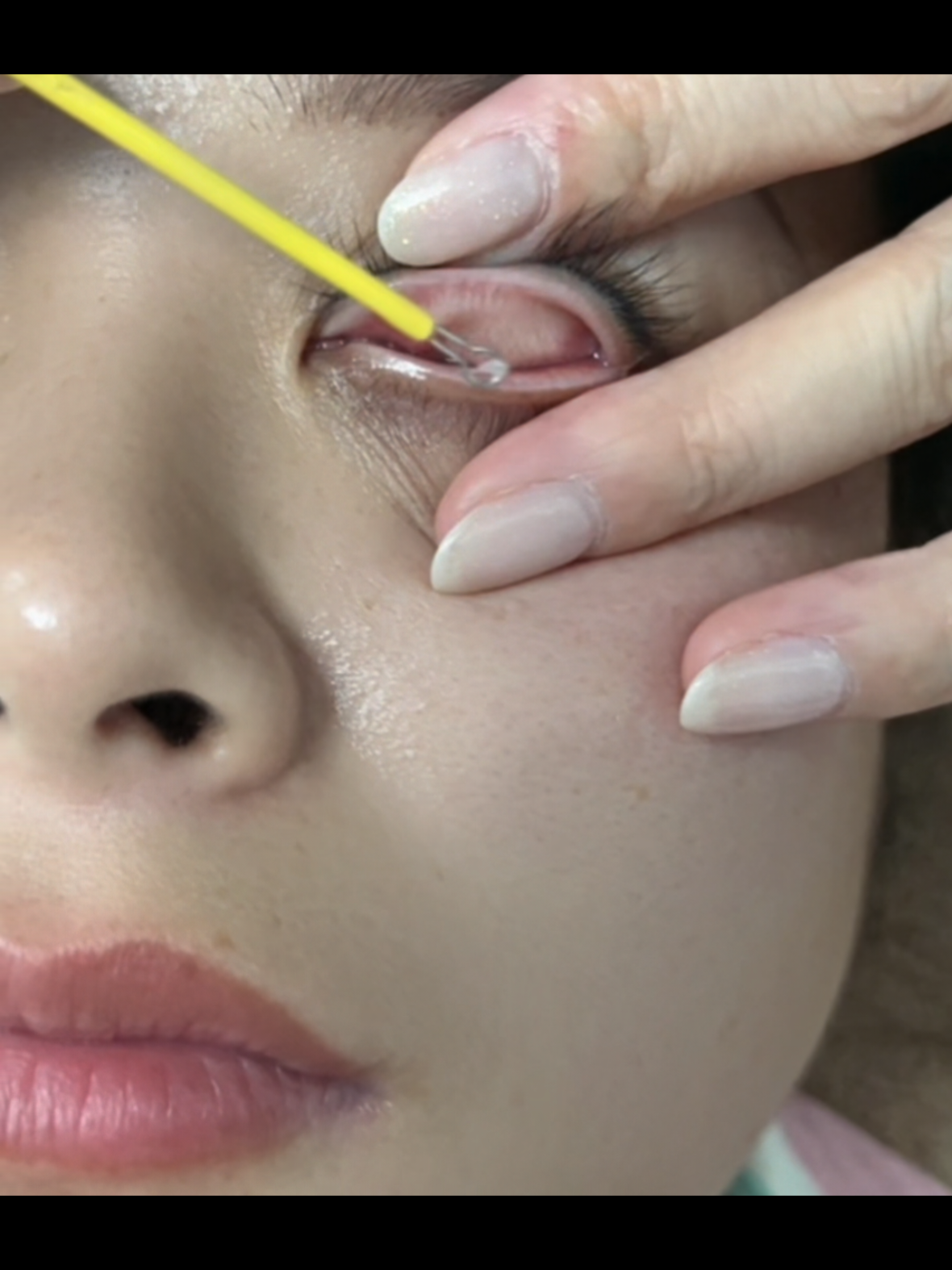 eye cleaning process  #foryoupage❤️❤️ #treatment #asmr 