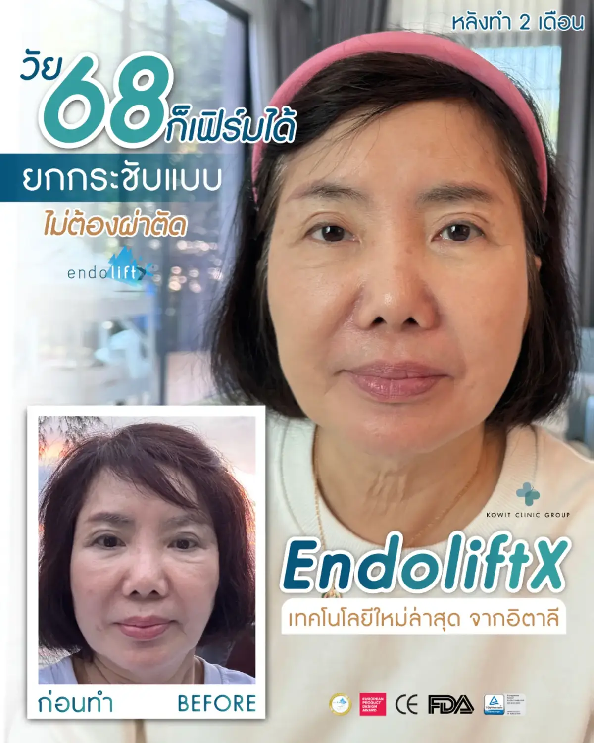 ✨ 68 ก็เฟิร์มได้! ✨ ยกกระชับ ปรับหน้าเด็ก ไม่ต้องผ่าตัด ด้วย EndoliftX ❤❤ . EndoliftX เทคโนโลยีล่าสุดจากอิตาลี 🇮🇹 เพื่อผิวตึงกระชับแบบเป็นธรรมชาติ! . 📌 หลังทำเห็นผลทันที 📌 เห็นผลชัดใน 3-6 เดือน 📌 ปลอดภัย ไม่ต้องพักฟื้น 📌 หลังทำสามารถใช้ชีวิตได้ตามปกติ 📌 ผลลัพธ์อยู่ได้นาน 3 - 5 ปี 📌 ยกกระชับ พร้อมสลายไขมันไปพร้อมกัน 📌 ไม่มีรอยแผลผ่าตัด 📌 ได้มาตรฐานยุโรป & FDA . เปลี่ยนผิวให้กระชับได้ โดยไม่ต้องผ่าตัด! . 😱😱 ของแท้ต้องจากอิตลีเท่านั้น 😱😱 ระวังของปลอม ลอกเลียนแบบ ไม่ได้ผลแถมอันตราย!!! . #EndoliftX #Endolift #ยกกระชับใบหน้า #lift #facelift #AestheticTrend #ภูเก็ต #ภาคใต้ #phuket #Italy #EndoliftThailand #เครื่องปลอมจากจีน #อ้างเป็นเครื่องจากเยอรมัน #เครื่องแท้จากอิตาลี 