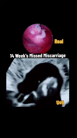 14 week's missed miscarriage during ultrasound scan #pregnancyjourney #pregnancyultrasoundscan #missedmisscarriage #babymissed #missedmisscarriage #pregnancymiscarriage #pregnancyfailure #draneelamanzoor 