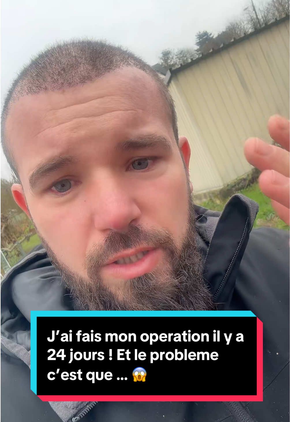 Il y a 24 jours aujourd’hui que j’ai fait mon opération 😱 ##gitan##manouche##gensduvoyage##donbran##niglo##operation##greffedecheveux##implant##implants##cheveux##cheveuxnaturel##capillaire##paris##france##travail##iveco##ivecodaily##benne##solution##daily##charge##nature##top##bien##viral_video##argent##salaire##fyp