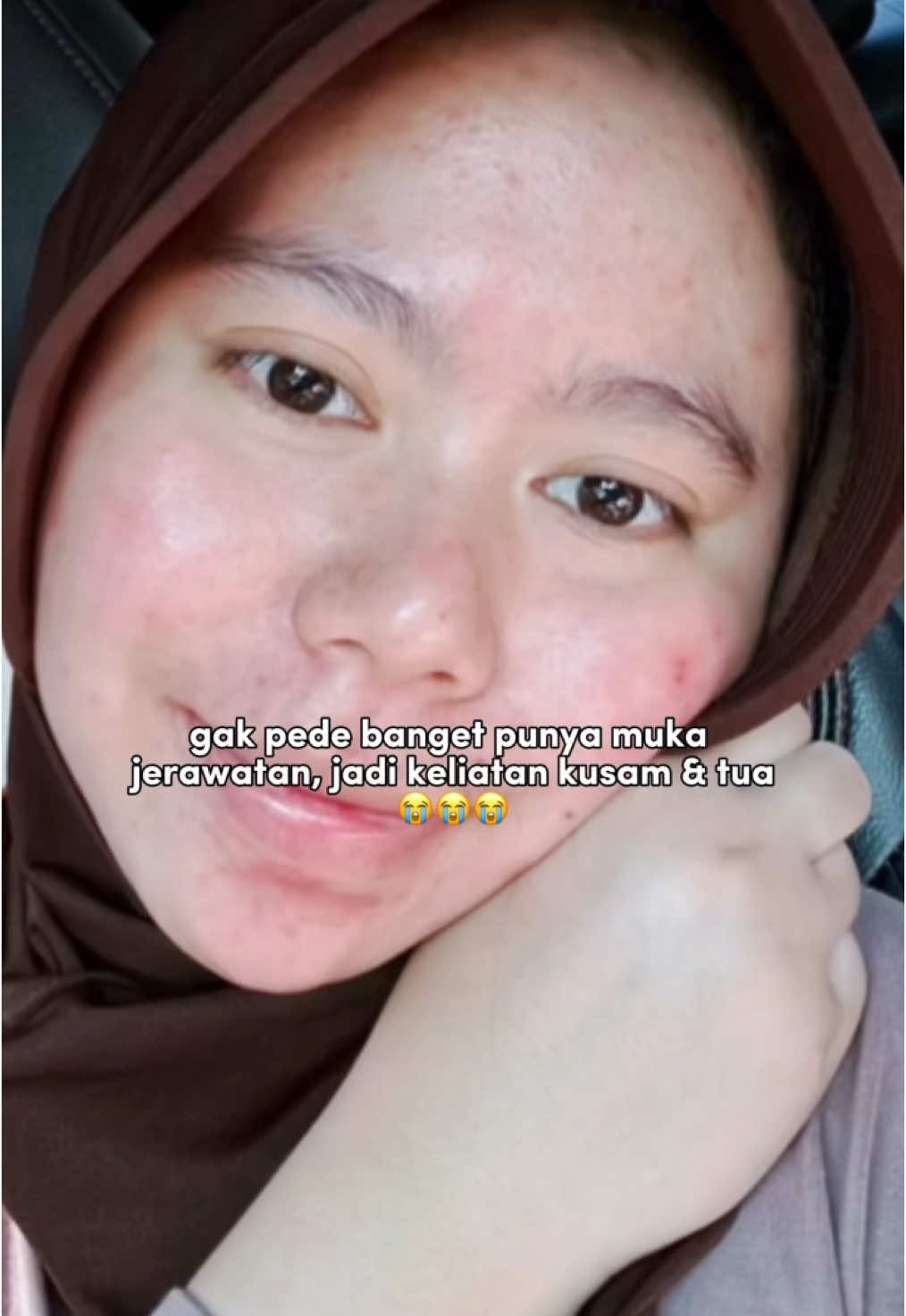 sudahi insecure-mu, mari glow up bareng bersama OshinBeauty-ku🙌💓✨ #oshinbeauty #skincare #bpom #halal #aman #acnefighter #proses #GlowUp #viral #fyp #xzybca 