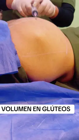 Volumen en glúteos con ácido hialuronico #Sculptra #SculptraAesthetic #SculptraTreatment #acidohialuronico 