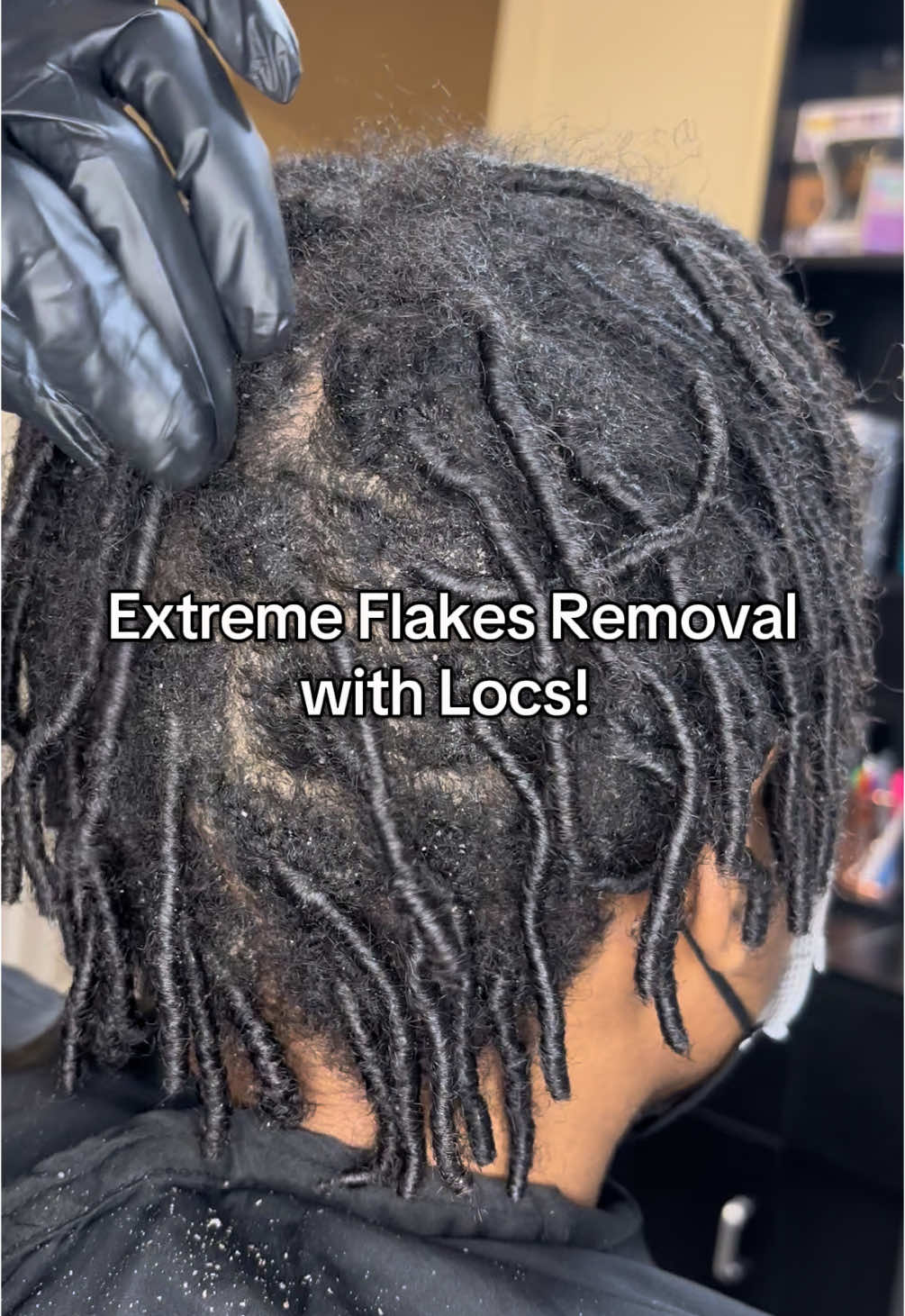 ✨ Scalp SOS: Activated! ✨ Watch this extreme seborrheic dermatitis transformation as I cleanse, soothe, and retwist these locs back to life! 🛁💆🏾‍♀️ Healthy scalp = healthy locs! Who else struggles with scalp issues? Drop a 💛 if you can relate! #ScalpCare #SeborrheicDermatitis #LocRetwist #HealthyLocs #locmaintenance #NaturalHairCare #fyp 