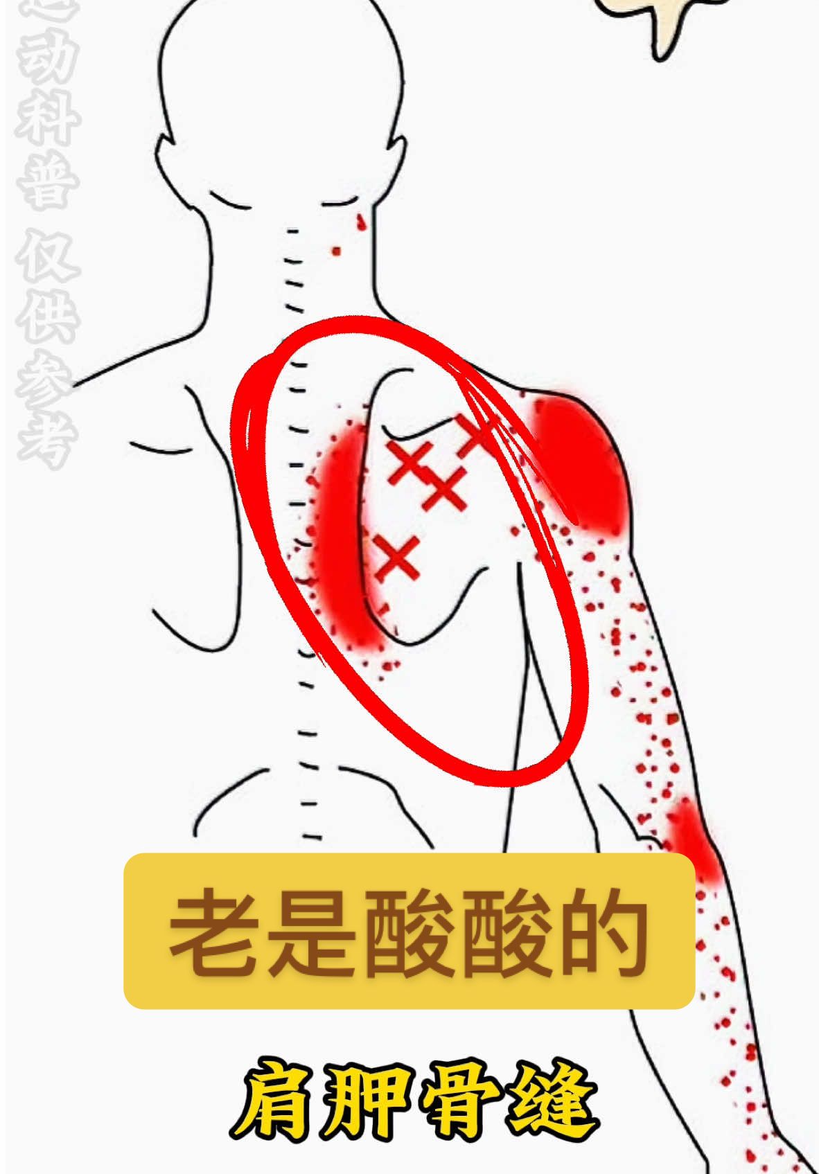 坐着就能缓解背痛手臂酸？快试试这 1 招！ 是不是肩胛骨缝总是酸酸的，还带着手臂前侧不舒服？ 很多人以为是肩颈劳损，其实很可能是菱形肌和冈下肌在作怪！ 	 ✅ 为什么会不舒服？ 长期含胸、耸肩或不良姿势，会让菱形肌和冈下肌过度拉扯， 从而引发肩胛骨缝僵硬、肩关节紧张，甚至手臂前侧的不适感。 🎯 今天教你一个简单动作，舒缓肩胛骨和手臂前侧！ 	 ✅ 动作步骤： 1️⃣ 双手手背贴于腹部，手掌朝向身体。 2️⃣ 手肘卡住膝盖内侧，保持稳定。 3️⃣ 大腿用力往内夹，尽量夹到最大极限。 4️⃣ 保持10个深呼吸，感受肩胛骨缝和肩关节被打开！ 	 📌 每次做3组，做完后肩背和手臂都会瞬间轻松！✨ 🎯 为什么有效？ 	 ✅ 释放菱形肌和冈下肌的紧张感 ✅ 缓解肩胛骨缝酸痛，改善手臂前侧僵硬 ✅ 增强肩关节的灵活性，提升肩背舒适度 	 📌 别光看着，快坐起来试试吧！做完记得告诉我你的感受～更多肩背放松技巧，记得关注我哦！😉#肩胛骨缝酸痛 #菱形肌放松 #冈下肌放松 #肩颈疼痛缓解 #手臂前侧不适 #肩关节健康 #含胸驼背矫正 #简单拉伸 #肩背护理 #疼痛缓解 #运动康复 #健康生活 #体态调整 #居家健身 #健身小技巧#ScapularPainRelief #RhomboidStretch #InfraspinatusRelease #NeckShoulderPain #ArmDiscomfort #ShoulderHealth #PostureCorrection #SimpleStretch #ShoulderMobility #PainReliefTips #HealthyLifestyle #PhysicalTherapy #BackCare #fitnesstips 