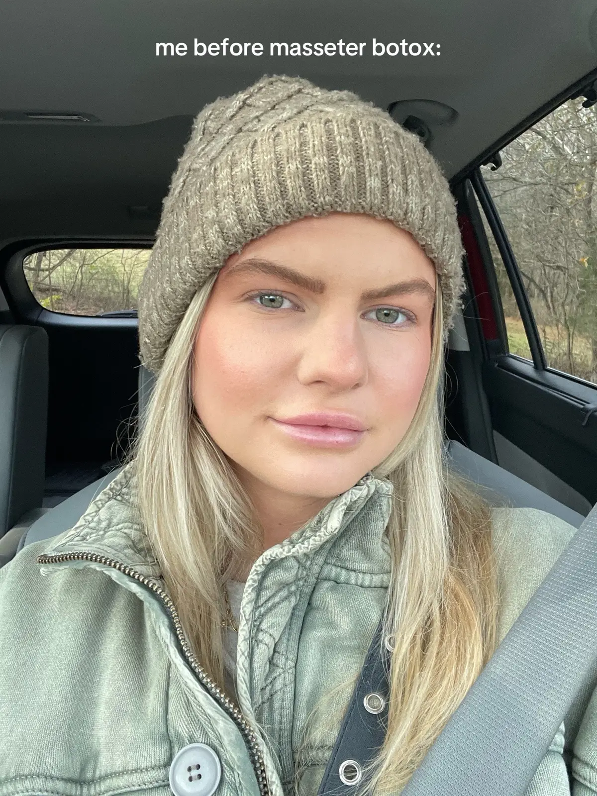 I’ve been getting masseter botox for a few years now but took about a year off this last year and just got them done a few weeks ago… here are my 2/3 week results! I feel like I see a huge difference in my face shape but maybe that’s just me 😂 #masseterbotox #botox #faceslimming 