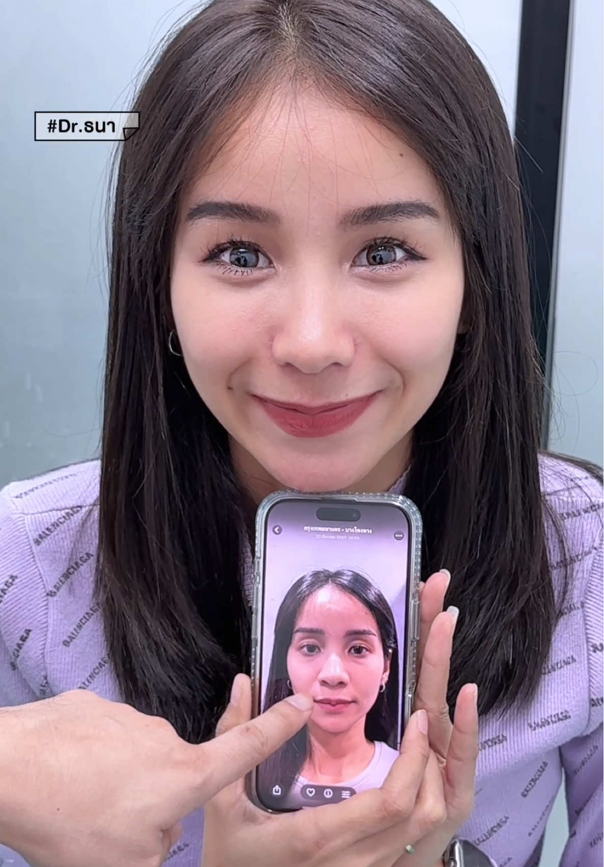 Update 1 เดือนละมุนไปหมดดดด🥺✨#eliteclinic #อีลิทคลินิก #eliteclinicthailand #ตัดปีกจมูก #หมอธนา 