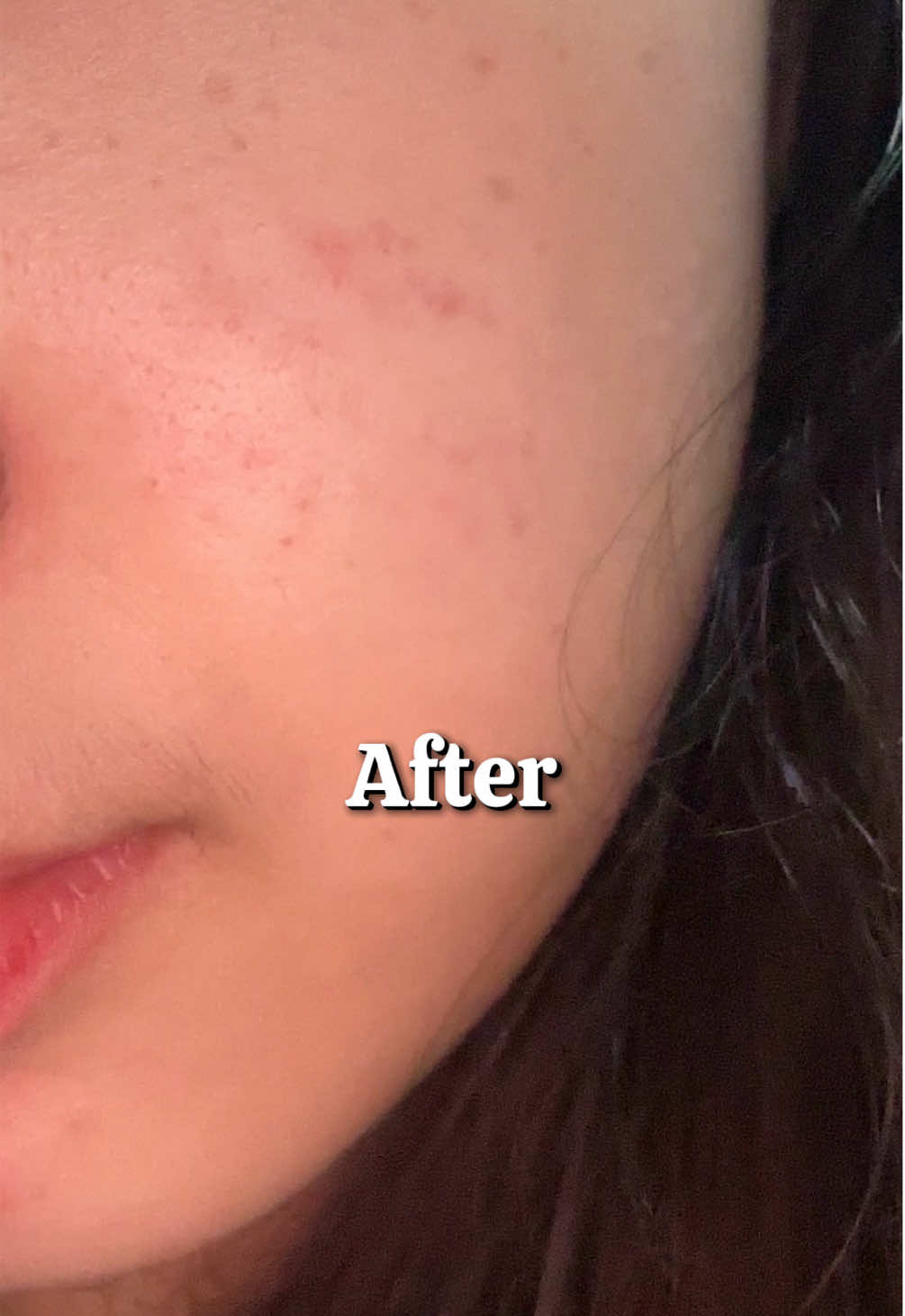 Before VS After pemakaian secara rutin, Infinite Beauty Acne Expert✨