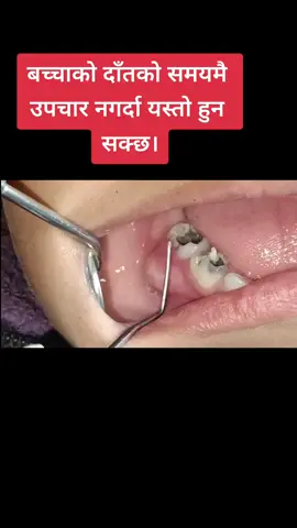 #drdevrajshrestha #shreekrishnaoraldentalclinic #oralhealthawareness #gingivalabscess #dentist #dentaldoctorinnepal #दाँत #fypシ゚viral #foryoupage #dentaldoctor #pulppolyp 
