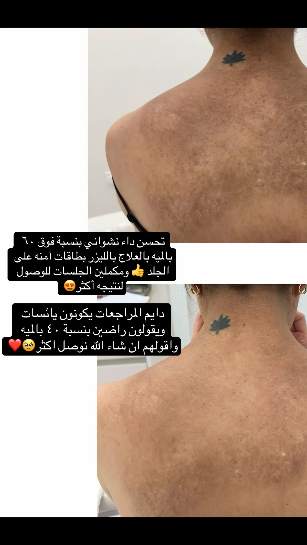 علاج الداء النشواني #الداء_النشواني #تصبغات #تصبغات_الوجه #اكسبلورexplore #fyp #foryourpage #الرياض #انتشار_سريع #اكسبلور 