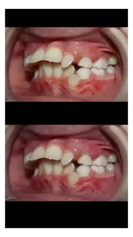 Before after pemakaian kawat gigi nih gengs!! makin rapi struktur giginya, makin percaya diri juga untuk senyum pastinya!! #dentalcare #gigi #perawatangigi #gigisehat #behelgigi #braces