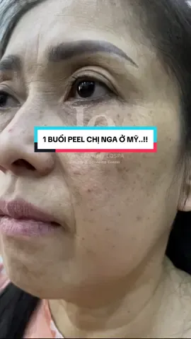 1 BUỔI PEEL CHỊ NGA Ở MỸ..!!#chamsocdamun#chamsocdaseo#chamsocdanam#tanbinh#govap #Le quynh#Lqspa#hocnghespa  #chamsocda #lequynhspa #lequynhspahcm#vienthammylqspa#lqspabeautyacdemy#LQSPABeaty&Acedemy 