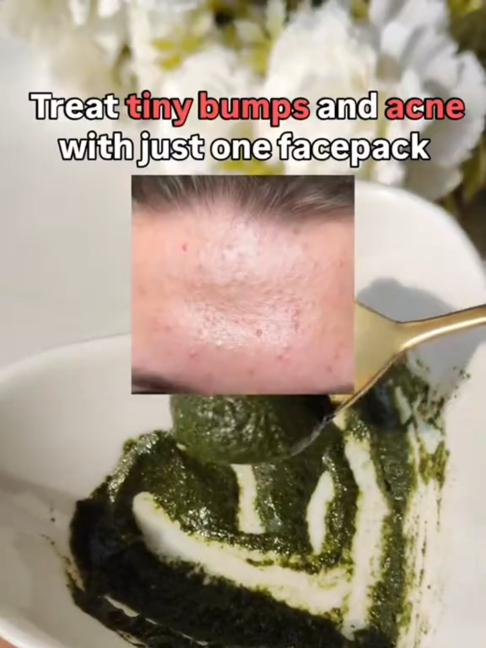 Try this neem facepack to treat tiny bumps acne & pimples #acnetreatments #tinybumps #pimples #pimplesolution #neem 