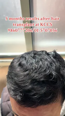 Anamnagar kathmandu. Near bajeko sekuwa anamnagar. You can find the exact location on google maps also if you search for “kathmandu clinic of cosmetic surgery”. Or you may call 015707056 or 9860777206 for details.#drmainali #kccsdermatology #skincare #goviral #kccs#glutathioneinjection #fyp #goviral #hydrafacial #haartransplantationalternative #hairtransplant 