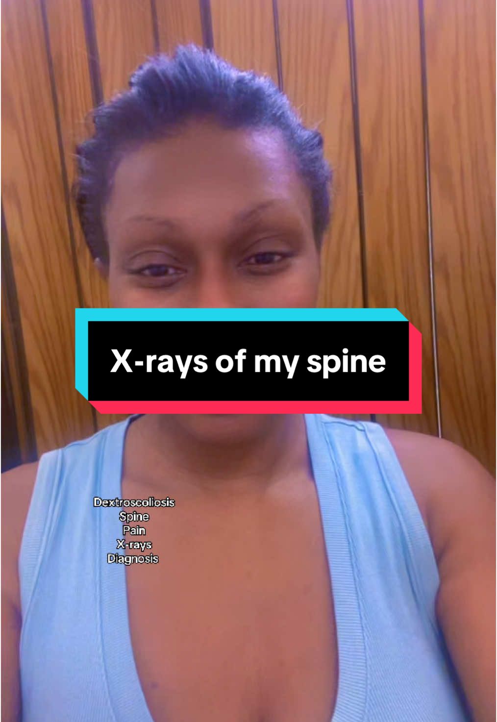 #fypシ #diagnosis #Spine #viralvideo #Health #dextroscoliosis #Scoliosis #X-rays #fyp 