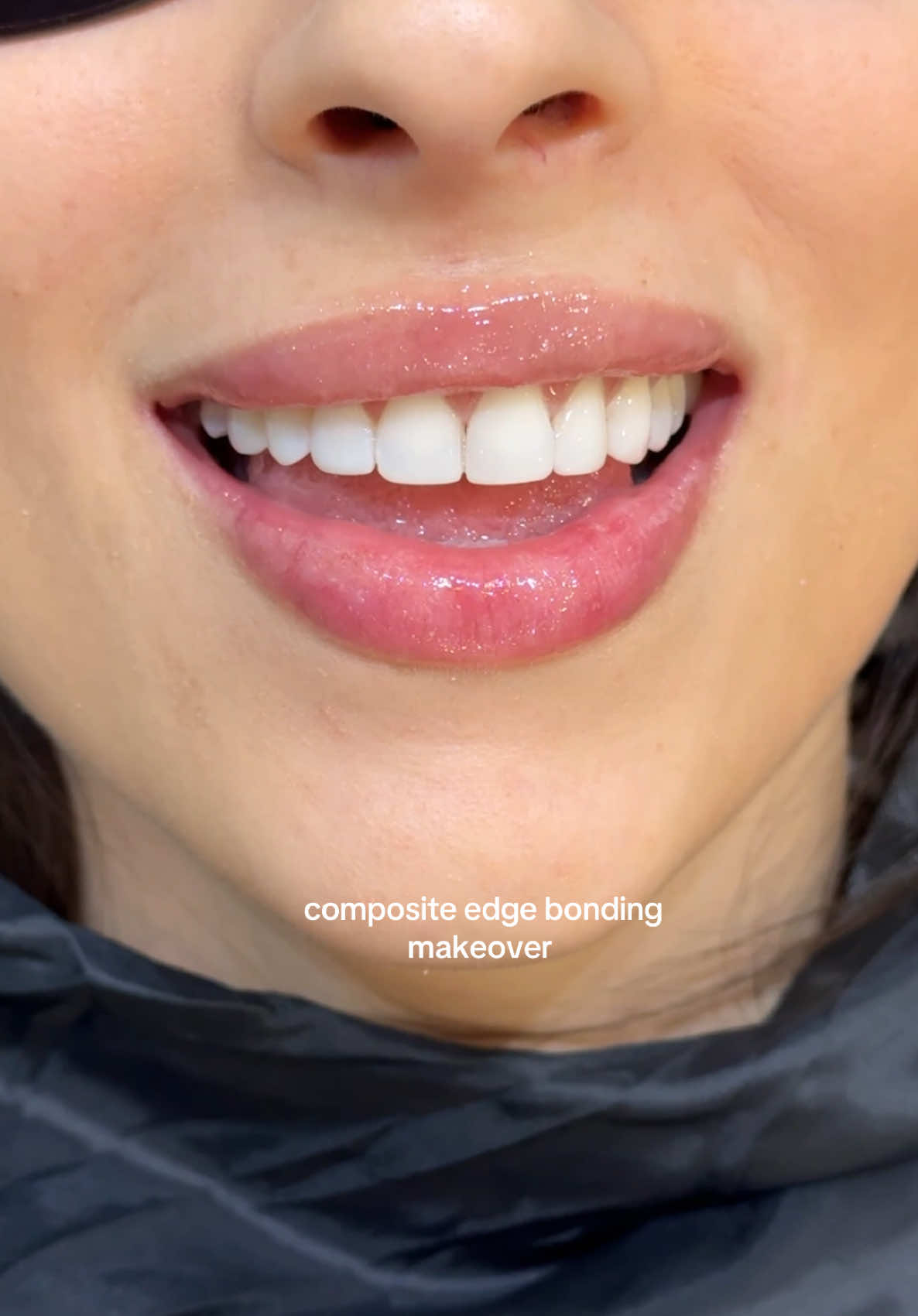 Composite edge bonding on 8 upper teeth 🤍