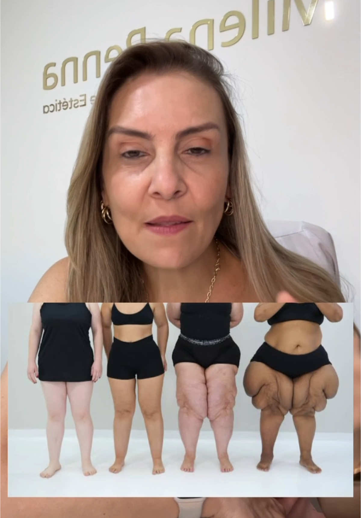 Você se identifica com alguma dessas pernas? 🤔 Preste atenção ao seu corpo! Descubra mais sobre essa condição e o que você pode fazer para melhorar sua qualidade de vida. Agende sua consulta e descubra o caminho para melhorar sua qualidade de vida. Vamos juntas nessa jornada!