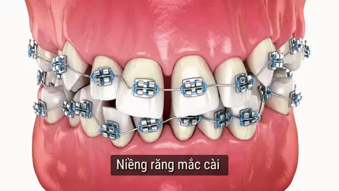 #anhnhasi #niềngrăng#nhakhoa 