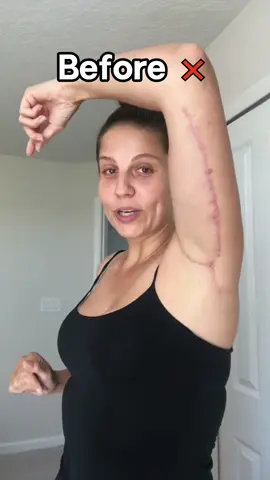 Make scars vanish safely with our adhesive scar patch. Try it right away. #scarremoval #TikTokBeauty #healing #skincare #effectiveproducts #tiktokshopblackfriday #blackfriday