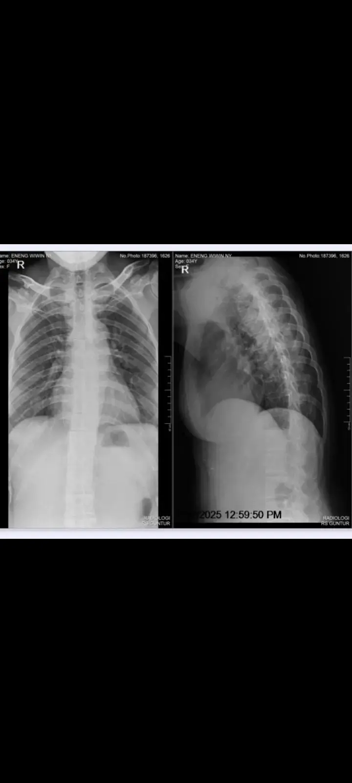 Kemarin Dokter mengatakan tulang belakangku sudah kaku walaupun di operasi takutnya mengakibatkan kelumpuhan karena sarafku yang akan kena, karena ketika di operasi tulangku harus di paksa dan di patahkan ketika ingin di luruskan lagi. Ya Alloh di malam Nisfu Sya'ban ini ku langitkan doaku semoga di ribuan doa yang di langitkan salah satu doaku yang engkau kabulkan ya Alloh, aamiin 🤲 Keinginanku untuk sembuh masih besar ya Alloh, semoga doaku mengalahkan Takdirku. aku menunggu kun fayakun mu,Ya Alloh🤲 #pejuangsehat #tbtulangbelakang 