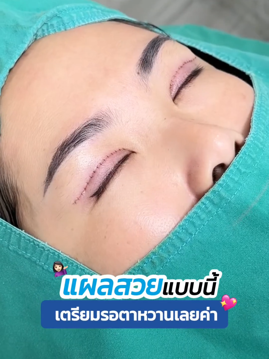 แผลสวยงานละเอียด #รีวิวตาสองชั้น #skyclinic #จักษุแพทย์ #ทีมแพทย์หมอสกาย #sweeteyes #ทําตาที่ไหนดี #หมอตา #คลินิกทําสองชั้น #ทําตาที่ไหนดี #ชั้นตาหลบใน #หนังตาตก 