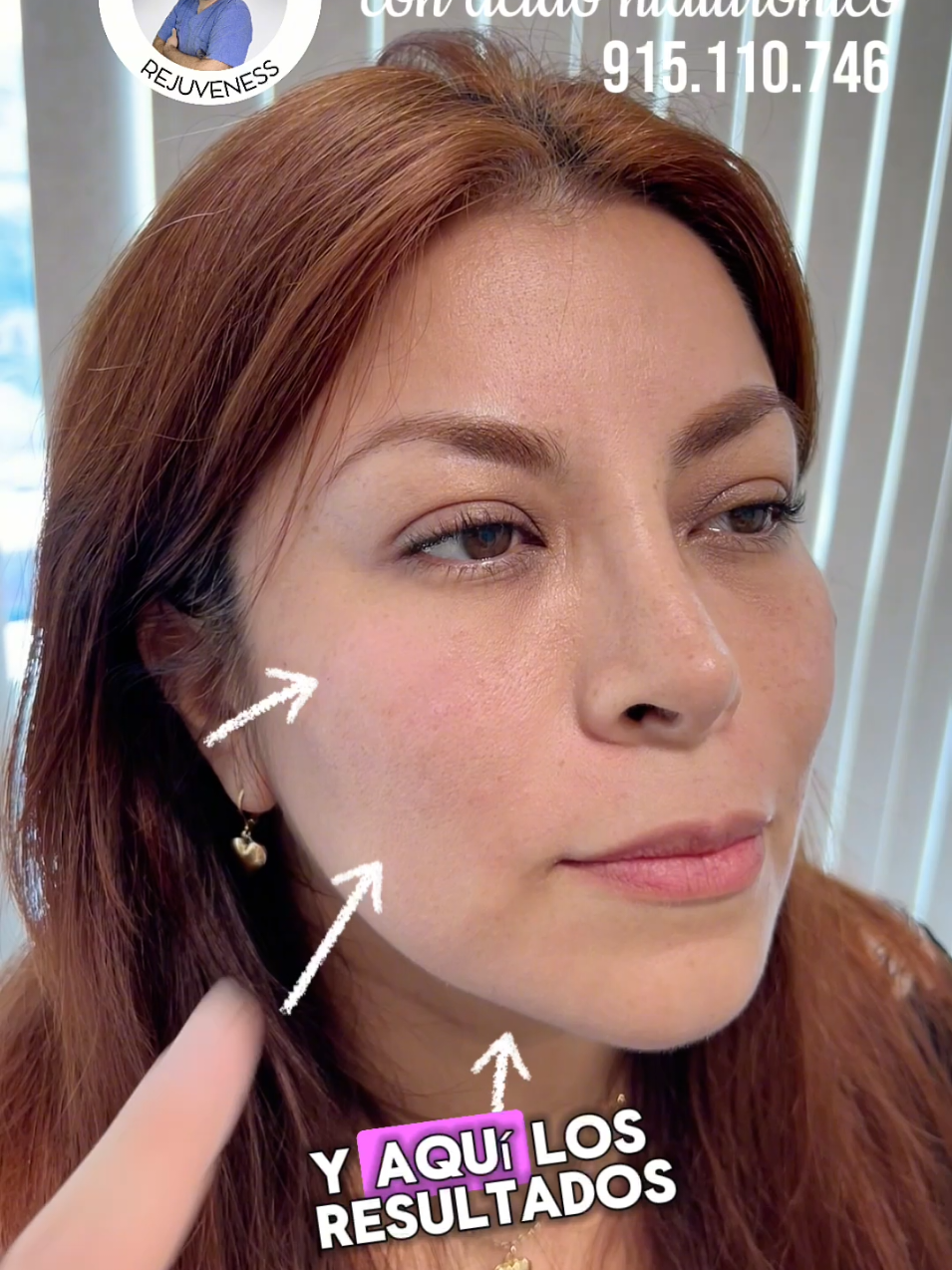 💉✨ Un retoque sutil para verte y sentirte increíble ✨💉 Con la técnica de puntos de anclaje, el Dr. Thomas Guzmán te ayuda a mejorar la flacidez, suavizar arrugas y darle un refresh a tu rostro en solo 30 minutos, sin cirugía. 📲 Agenda tu cita al 915.110.746 / 982.881.106. ¡Te va a encantar! #ÁcidoHialurónico #PuntosDeAnclaje #RejuvenecimientoFacial #SinCirugía #Filler #Lima #Miami #NewJersey 