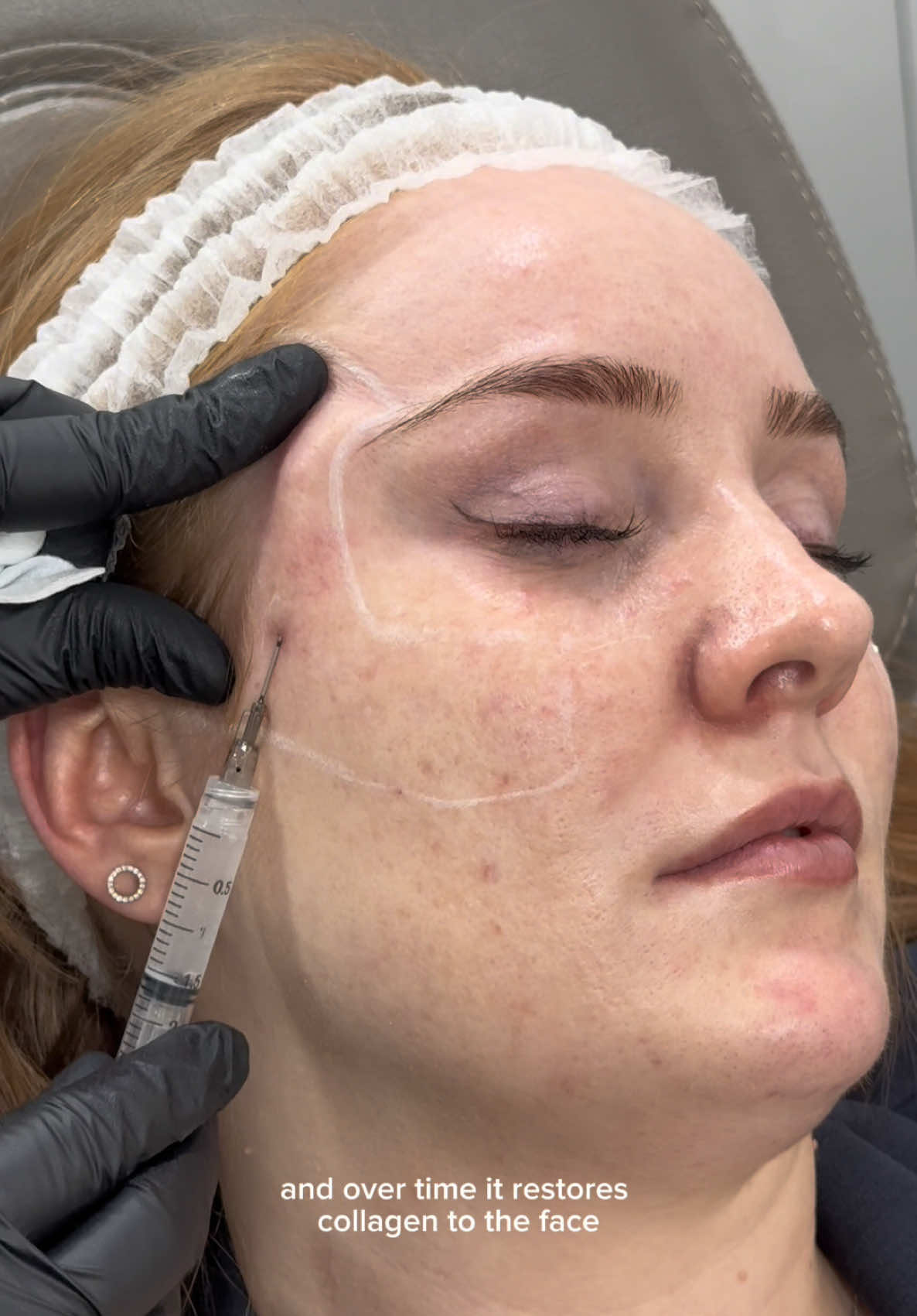 Are you dreaming of trying Sculptra but feeling unsure? 👀 Don’t worry – we’re here to help! All of our expert doctors have been offering Sculptra in our clinics for more than 10 years delivering stunning results that last 2-3 years 🔥This game-changing treatment is quickly becoming one of our most popular options for a youthful glow. If you’re considering it, book a consultation today, and our team will guide you through every step and address all your concerns!  Have any questions? Feel free to ask here, and our doctors will be happy to answer! #sculptra #sculptrafacial #injections #skinrejuvenation #collagenboost #hydratedskin 