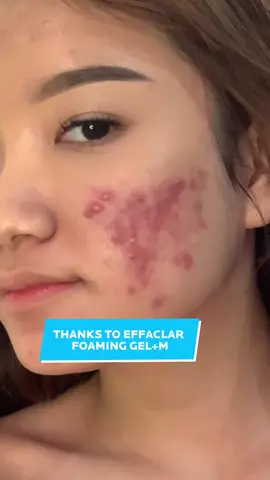 Spill facial wash La Roche Posay yang bisa bantu lawan jerawat 👀 check out sekarang! #facialwash #oilyskin #acne #SKINLIFECHANGER #LaRochePosayID 