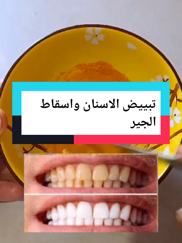 #وصفة طبيعية لتبييض الاسنان واسقاط الجير#تبييض #الاسنان #forypupage #zoommyface #الشعب_الصيني_ماله_حل😂😂 