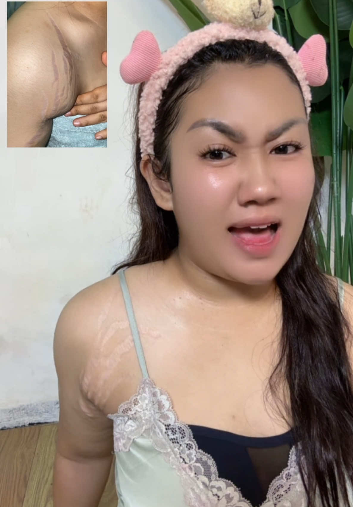 Gara gara kalian gw bukak aib😭 #solusistretchmark #pemudarstrechmark #rintikoilstrechmarck #oilrintikstrechmark #stretchmarkrintikskincare 