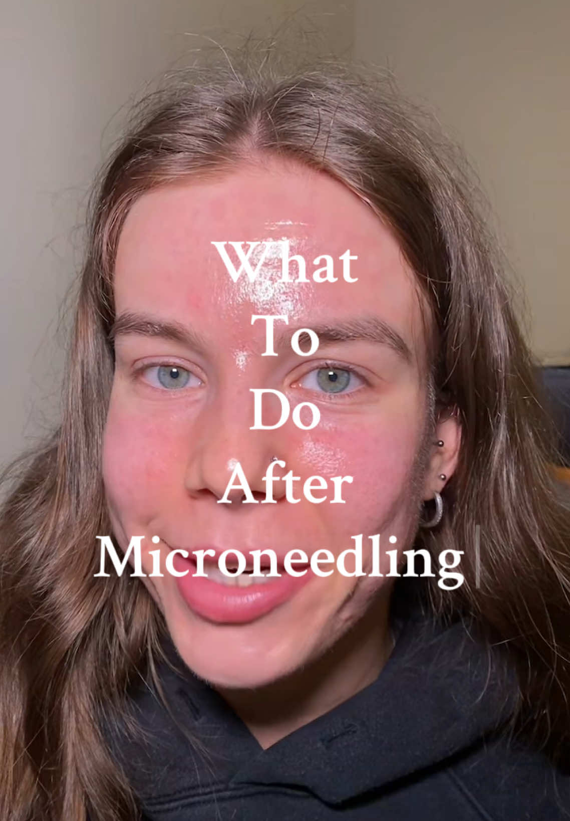What to do after you’ve had Microneedling… some aftercare advice I follow to avoid breakouts after Microneedling. Your facialist may give different advice but this is what I have been advised and what works for me #microneedling #microneedlingaftercare #acnescartreatment #aftercare 
