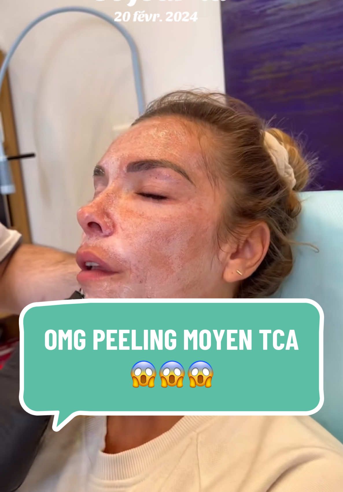 #cejour-là voilà ce qui a sauvé MA PEAU. Les peelings moyen TCA 😊 Merci @Le Six Foch 💉 #lesixfoch #montpellier #peelingmoyentca #peelingskin #peelings #skincare #peauparfaite #peau #acné #nimes #peelingsolution #solutionacné #peauacneique #pourtoi #drole #foruyou #foryoupagе #viral_video 