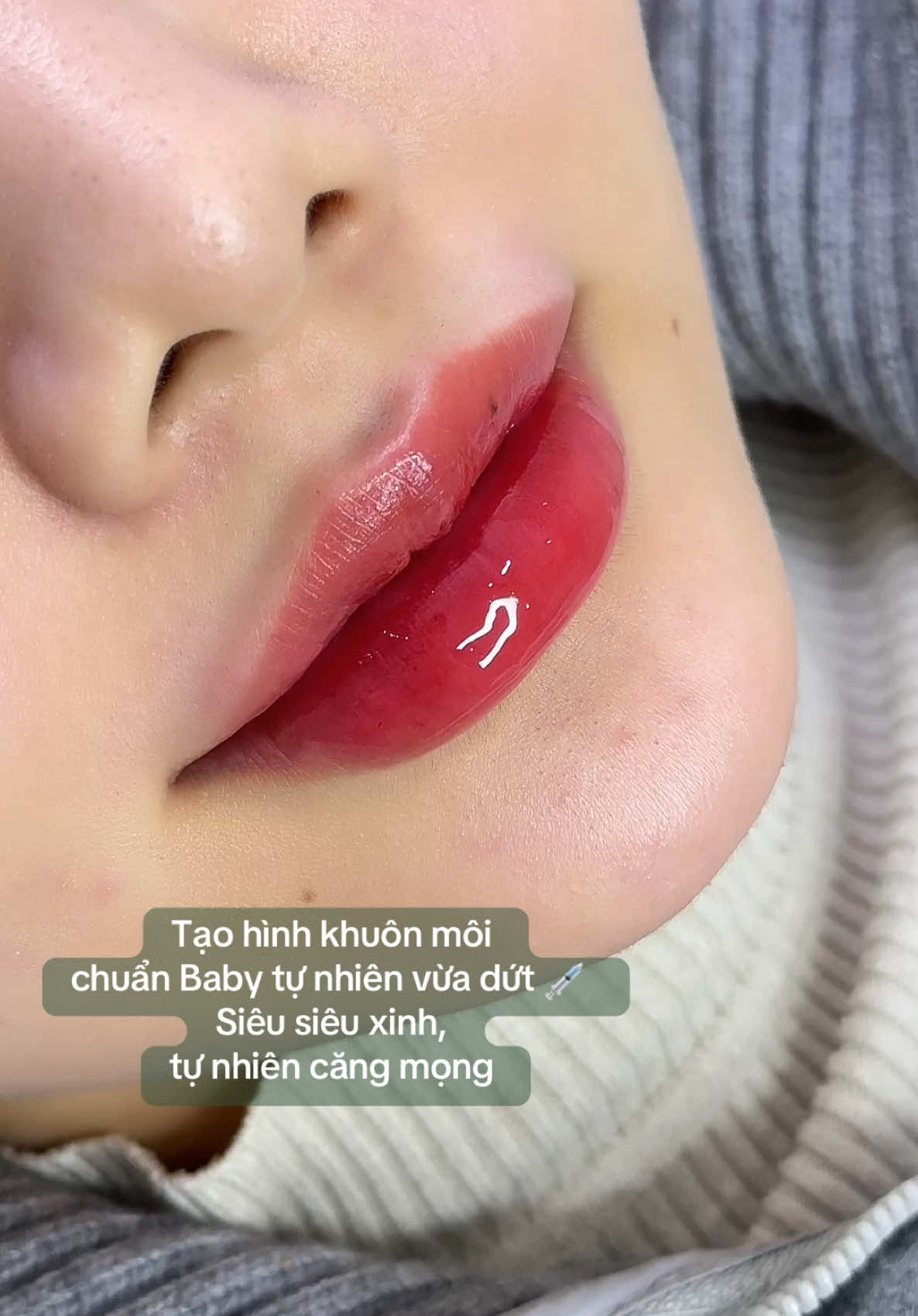 Lười up ảnh nên up vid cam thường cho ce ngắm 😜 #filler #botox #CléAnhBeauty #CayHA #FillerMoi 