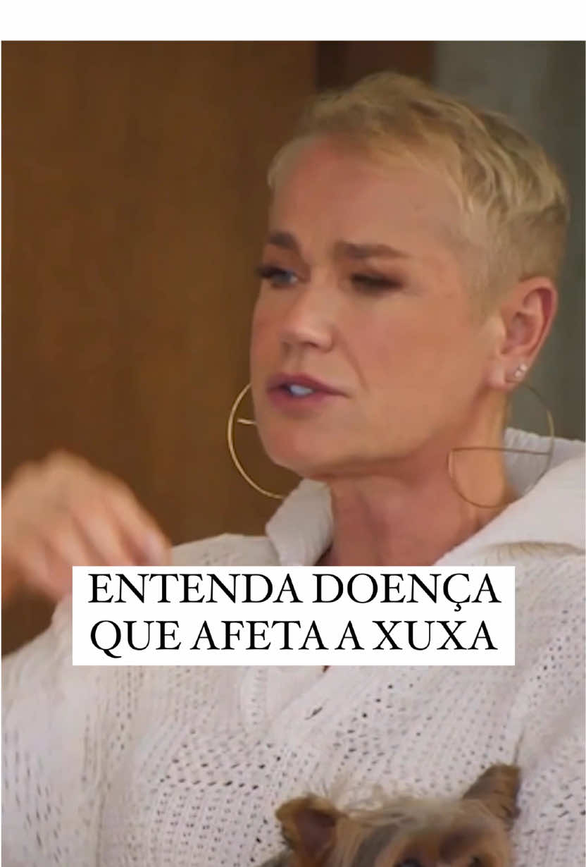A alopécia androgenética é muito conhecida como calvície hereditária. Essa é a principal causa de queda de cabelo em homens e mulheres. Seu surgimento está diretamente relacionado à genética, desequilíbrio hormonal, envelhecimento, estresse e estilo de vida. Os principais sintomas são o afinamento progressivo dos fios, o recuo da linha capilar e a perda de volume no topo da cabeça. Tratamentos disponíveis: 💊 Medicamentos tópicos e orais 🩺 Terapias a laser e microagulhamento 🧴 Shampoos específicos 💉 Transplante capilar (casos avançados) Lembre-se: quanto antes iniciar o tratamento, melhores os resultados! #alopecia #alopeciaandrogenetica #cabelo #transplantecapilar #quedadecabelo #envelhecimento