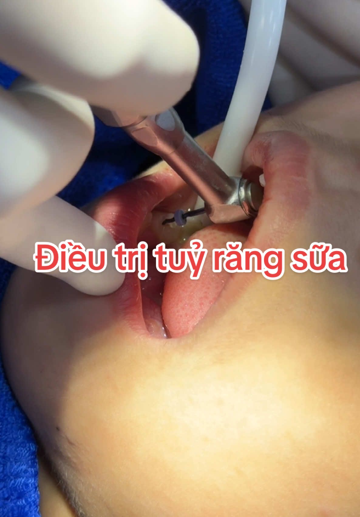 Ba mẹ cho con đi khám răng định kì để k phải điều trị như này nhé #nhakhoa #dieutrituyrang #xuhuong 