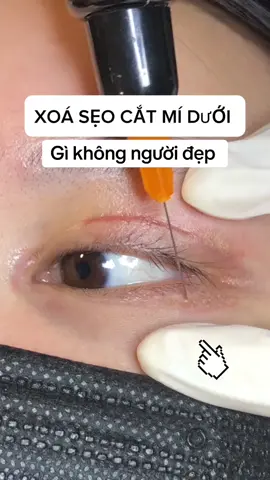 XOÁ SẸO CẮT MÍ DƯỚI #sẹo #sẹo_lõm #sẹo_mí_mắt #sẹo_rỗ #dieutriseo #plasma #beauty #Qxbeauty_coldplasma #xuhướng 