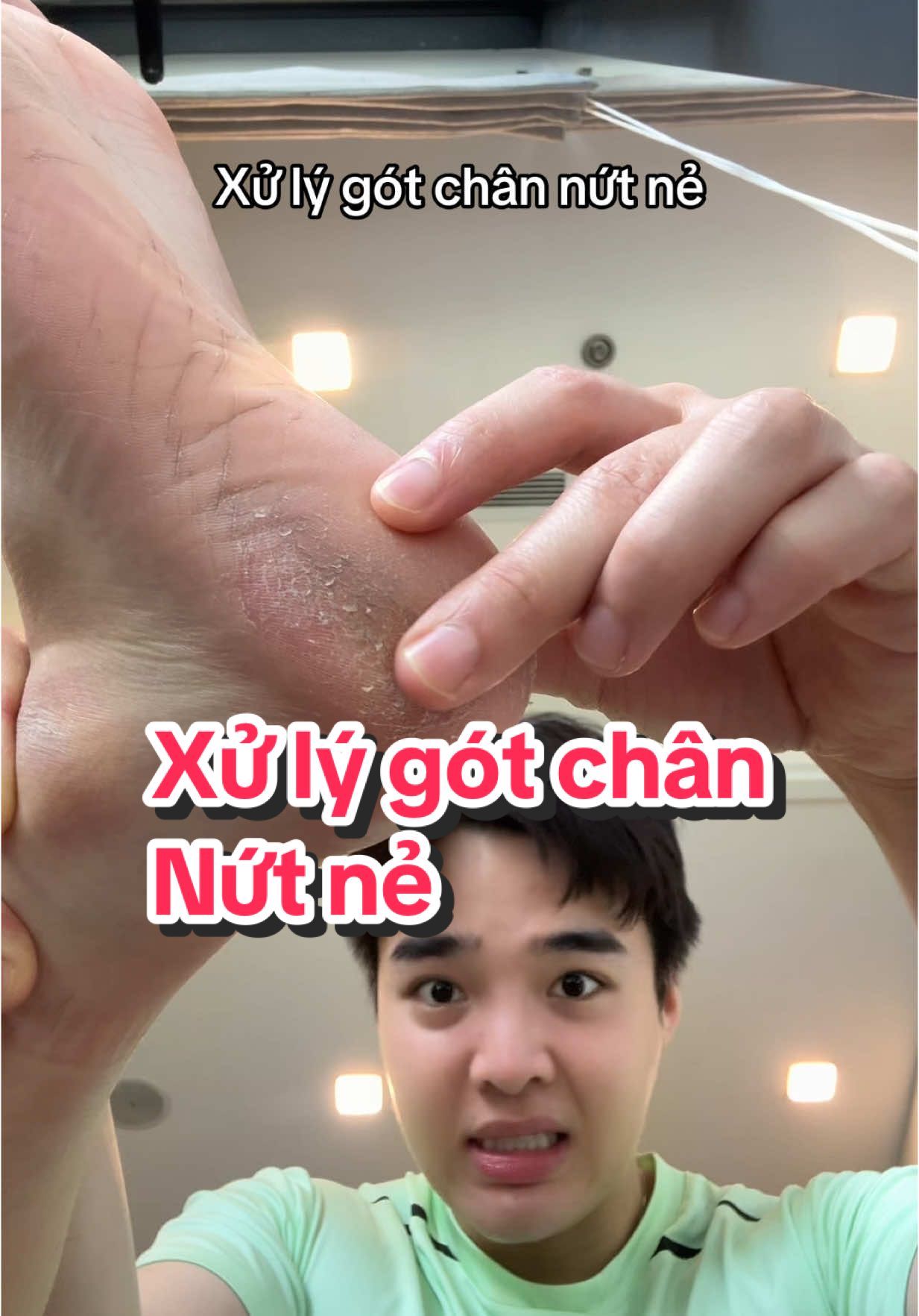 Cách xử lý gót chân nứt nẻ