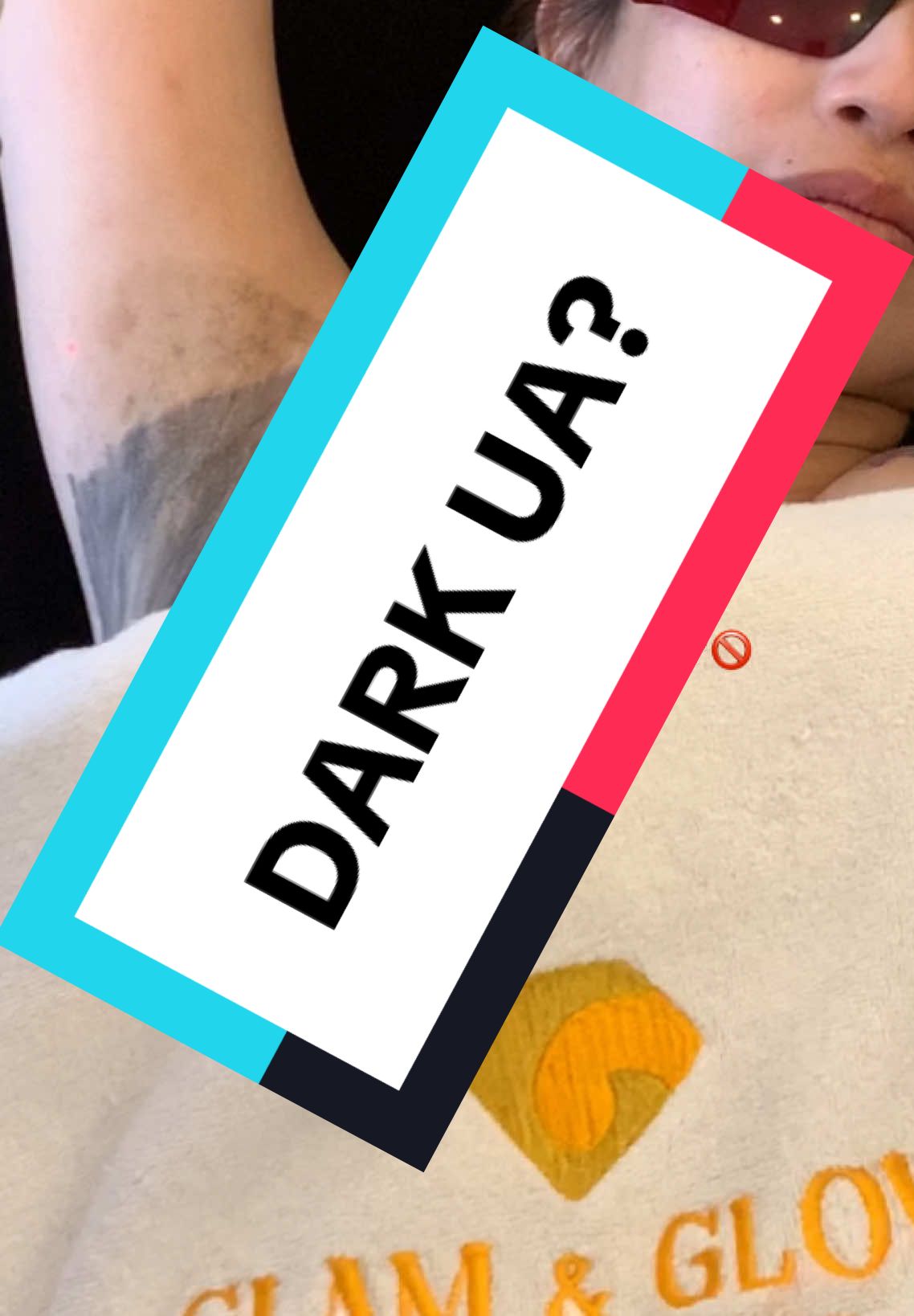 Say goodbye to dark underarms with Carbon Laser! ✨ Safe, effective, and perfect for all skin types. Book your session now and glow with confidence! 💖 #CarbonLaser #UnderarmWhitening #GlowUp #foryoupage #fuppppppppppppppppppppppppp #glamandglowph