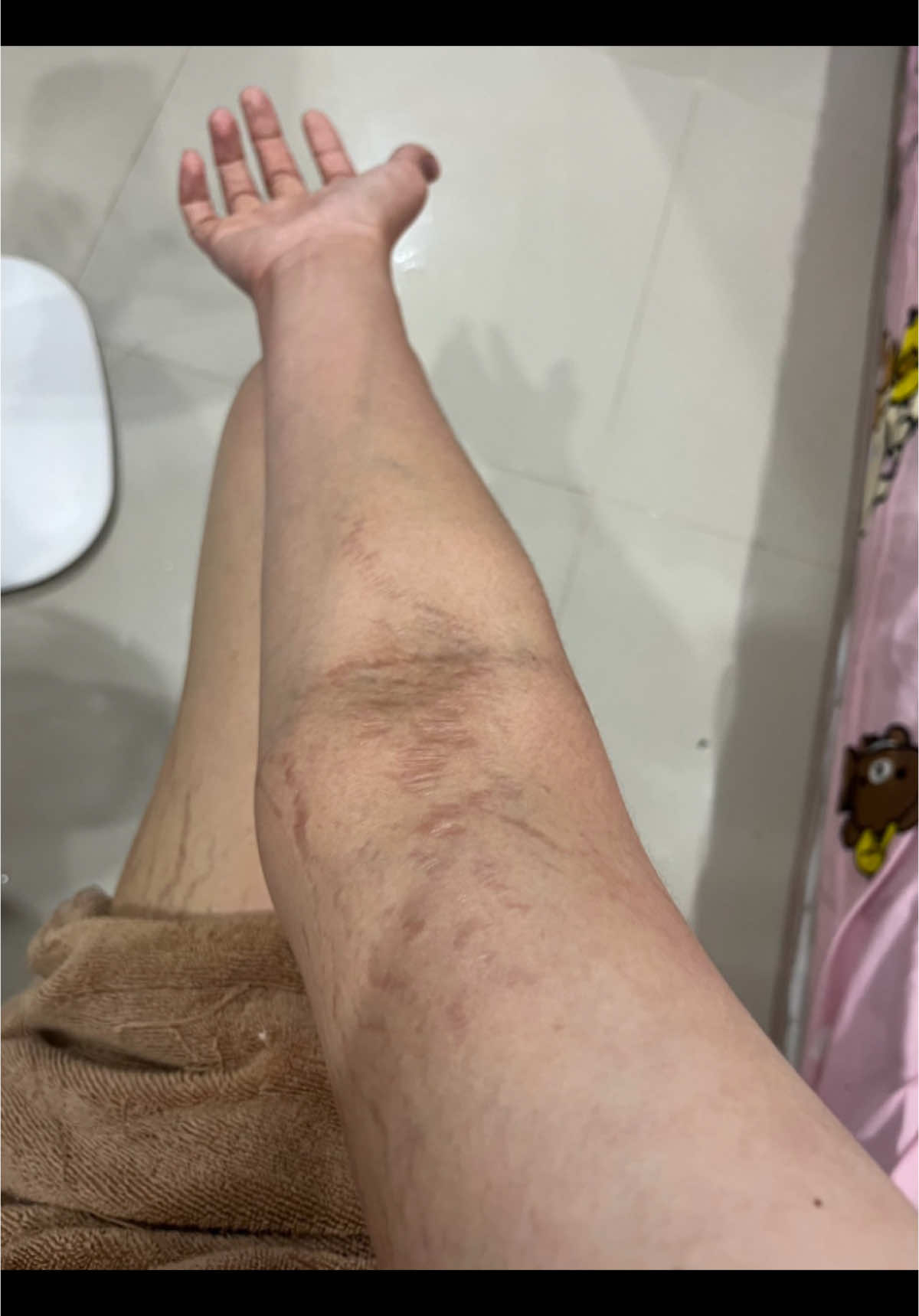 ขอบคุณรีวิวจากลูกค้าค่าา 🥰#ครีมทารอยแตก #นิวไวท์ #รอยแตกลาย 