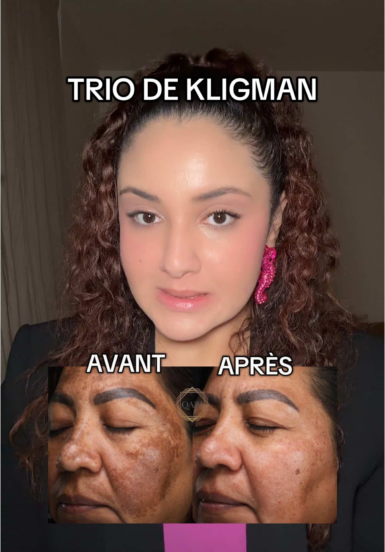 Si tu as des taches brunes ou un melasma, écoute attentivement cette vidéo… je vais te partager un secret bien gardé des dermatologues : le trio de Kligman #melasma #hyperpigmentation #tachesbrunes #pigmanorm #tretinoin #soindelapeau #skincarefrance #hydroquinone #conseilbeauté  @The Ordinary @Paula’s Choice FR #eucerin @TOPICALS 