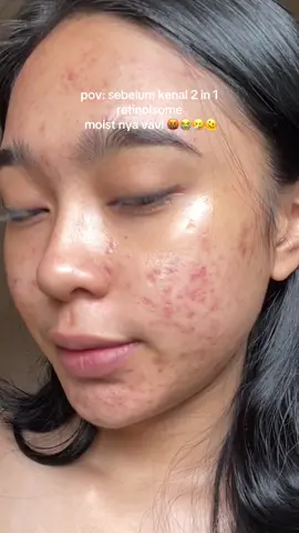 dosting tp sensitive skin friendly!🫶🏻