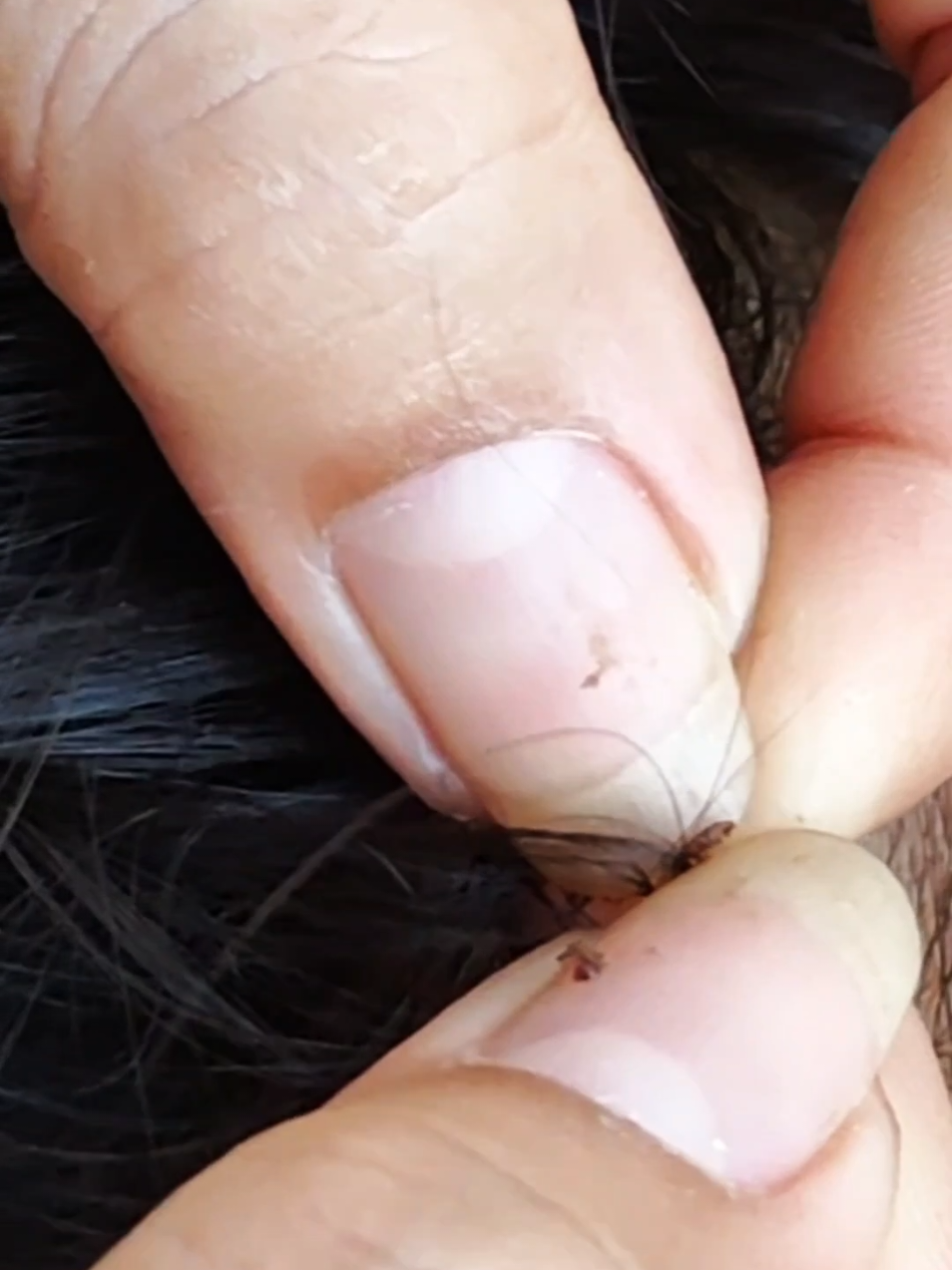 Lice Removal 18 #omg #lice #tripofobia #liceremoval #licetreatment #hairlice