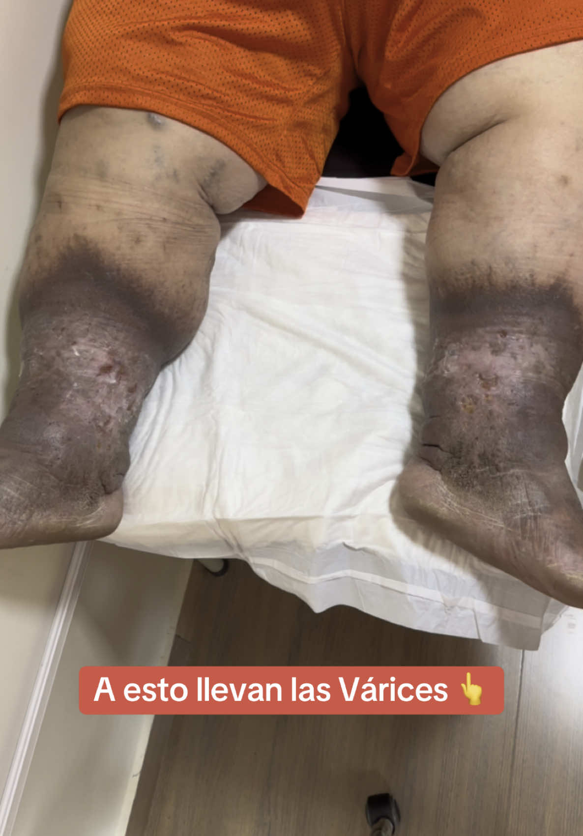 🏩 Las Úlceras Varicosas 😱👆 son el resultado de no tratar tus Várices a tiempo @The Vein Doctor 👨‍⚕️ 📲+593995178395/+593958757917 #varices #ulceravaricosa #varicesenlaspiernas #ulceravenosa #venasvaricosas #varicoseveins #varicesyarañitas #arañasvasculares #cristianbravo148 #cirugiavascular 