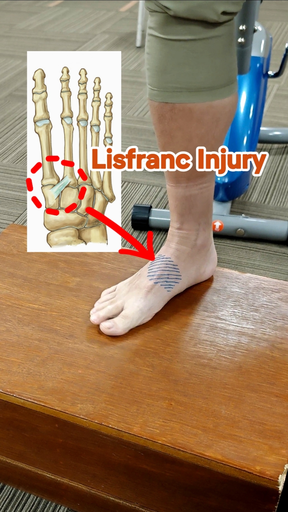 What is a Lisfranc Injury?! #lisfrancinjury #lisfrancfracture #lisfrancrecovery #lisfrancsurgery #physioleslie 