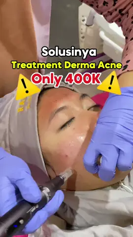 kata siapa treatment Dermapen sampai 500 ribu, di klinik radelya cuma 400ribu loh🤪🤭 ________ GRATIS, Konsultasi Dokter! BUKA SETIAP HARI ⏰ 9 pagi - 7 malam ⏰kecuali minggu / tanggal merah 9pagi- 5 sore.    Follow akun kami untuk informasi  terbarunya  Instagram : @klinik_radelya Tiktok : @klinik_radelya RSV wa : +62 823-7508-4316 _________ 📍maps klinik kecantikan radelya  Jl pramuka,sumber rejo kec.kemiling bandar lampung (Sebelum fly over kemiling)