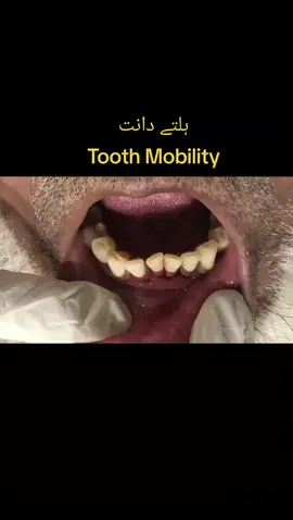 #tooth #mobility #loose #teeth #ateeqdentalcare #faisalabad #pakistan #4upage @Ubherta Sitara 