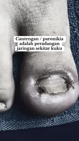 Cantengan / Paronikia adalah pertumbuhan kuku tidak normal akibat adanya peradangan pada sekitar jaringan kuku.  cantengan tidak kunjung sembuh lakukan tindakan partial nail extraction untuk membantu mengurangi infeksi dan pertumbuhan kuku kembali normal ☺️ @Bu Mita @KLINIK UTAMA SKINDAILY  #fyp #cantengan #kontenedukasi #paronychia #klinikkulit #aestheticclinic #aesthetic #dokter #doctor #aestheticdoctor 