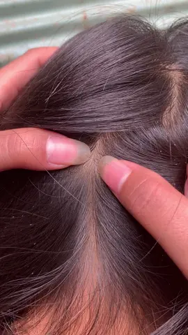 lice removal #omg #lice #liceremoval #treanding 