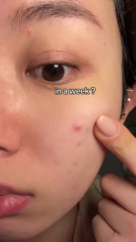 PIE acne mark gone in a week ?? This Centella ampoule is literally gold in a bottle 😩💛 #skin1004 #inaweek #acne #acnemark #acnefighter #acneproneskin #oilyskin #acnetreatment #acnetreatments #skin1004ampoule #creatorsearchinsights 