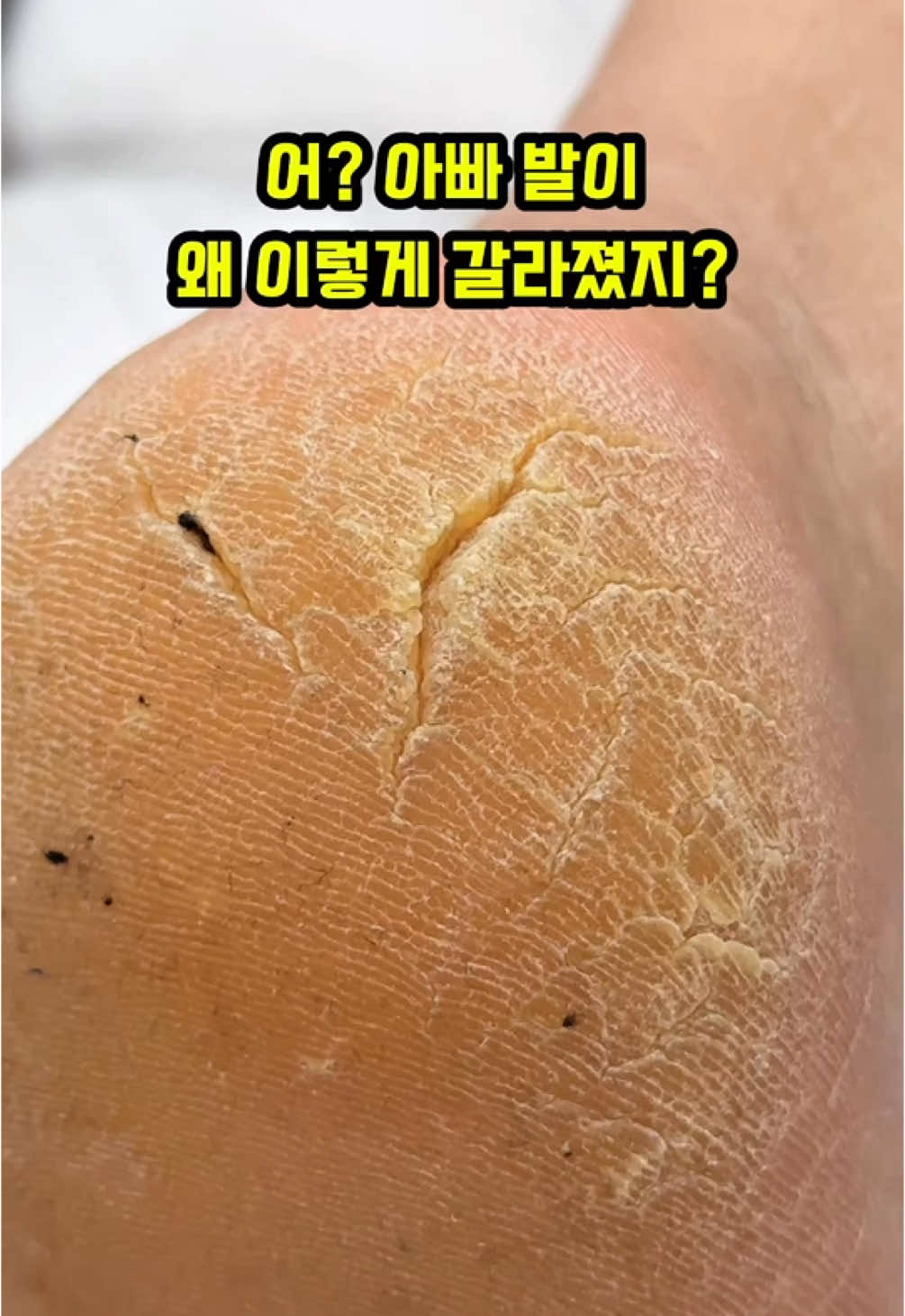 🚨 발뒤꿈치가 갈라졌어요 🚨 구리에서 가평까지 먼 길을 달려와 주신 따님과 70대 아버님. 오른발 뒤꿈치가 깊이 갈라져 걱정되셨을 텐데, 피부가 찢어진 건 아니라서 정말 다행이었죠. 갈라진 굳은살 때문에 많이 불편하셨을 텐데 1시간 케어 후에 발이 매끈해졌어요! 부녀가 함께 행복해하시는 모습에 저도 덩달아 마음이 따뜻해졌답니다. ═══════════════════ 📭 발 갈라짐 고민인 친구에게 공유 🔍 굳은살 제거에 대해 더 알고 싶다면 @footcarebyleah 팔로우! 📩 질문이 있다면 댓글로 남겨주세요💬 💌 도움이 되셨다면 좋아요❤️ ═══════════════════ 「 굳은살 제거 전문 리아 풋케어 」 왜 멀리서도 오시냐고요? 이유는 간단합니다. ╰┈➤ “잘 하니까요.” 🌟 대표원장이 상담부터 시술까지 직접 케어 🧼 위생적인 환경과 철저한 소독 멸균 시스템 💯 투명한 가격 정책 / 불필요한 제안 없음 💅 다양한 발관리 프로그램 운영 📞 상담 문의 : 네이버 톡톡 or 카카오톡 🕰️ 방문 예약 : 프로필 링크 📍 주소 : 경기도 가평군 가평읍 석봉로 166 1층 리아풋케어 #굳은살제거 #발각질케어 #패디플래닝 #drypedicure #medicalpedicure #footcare #crackedheelstreatment #callus #callusremoval #callusremover 