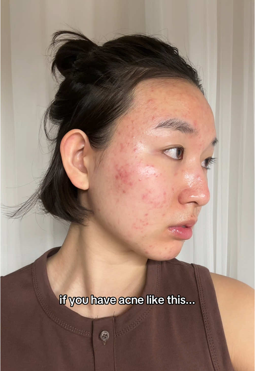 a skincare hack that's not viral but should be! acne prone/sensitive skin girlies this is for you🫶 #acne #acnefighter #acneproneskin #skincare #sensitiveskin #acnecream @dr.althea_official #345cream 